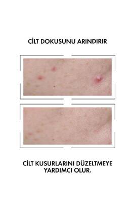 Vichy Normaderm Probio Bha Peeling Etkili Cilt Kusuru Karşıtı Serum 30 ml - 2