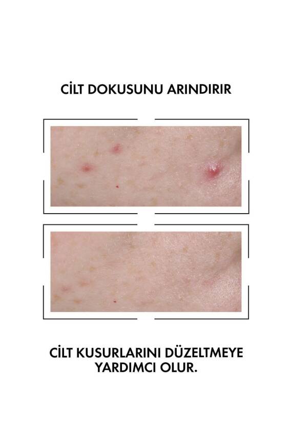 Vichy Normaderm Probio Bha Peeling Etkili Cilt Kusuru Karşıtı Serum 30 ml - 2